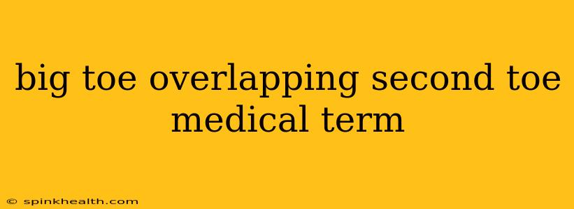 big toe overlapping second toe medical term
