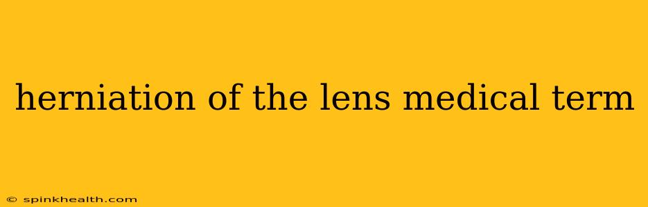 herniation of the lens medical term